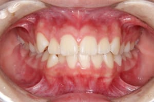 前歯部の叢生、前歯の突出があります